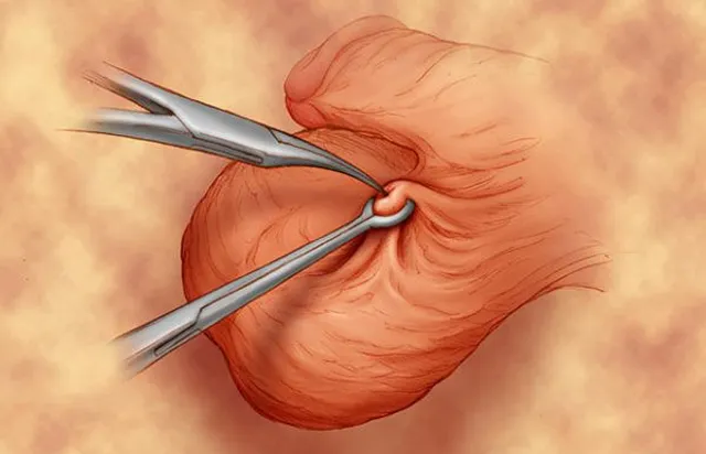 vasectomia-campo-mourao-urologista