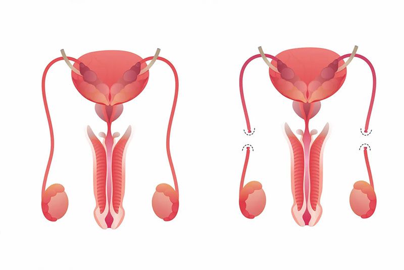 vasectomia urologista campo mourao dr eufanio saqueti